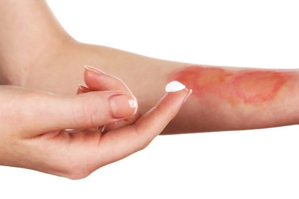 بهترین راه درمان سوختگی